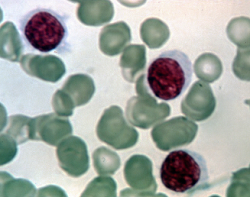 slide of leukemia cells