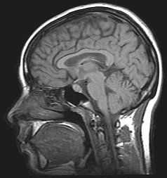 mri image of the brain