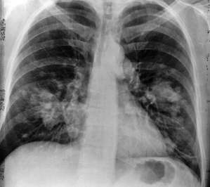 x-ray of someone with lung cancer